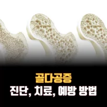 골다공증-증상-치료-예방