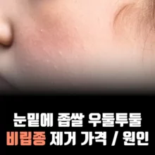 비립종-제거-가격-원인