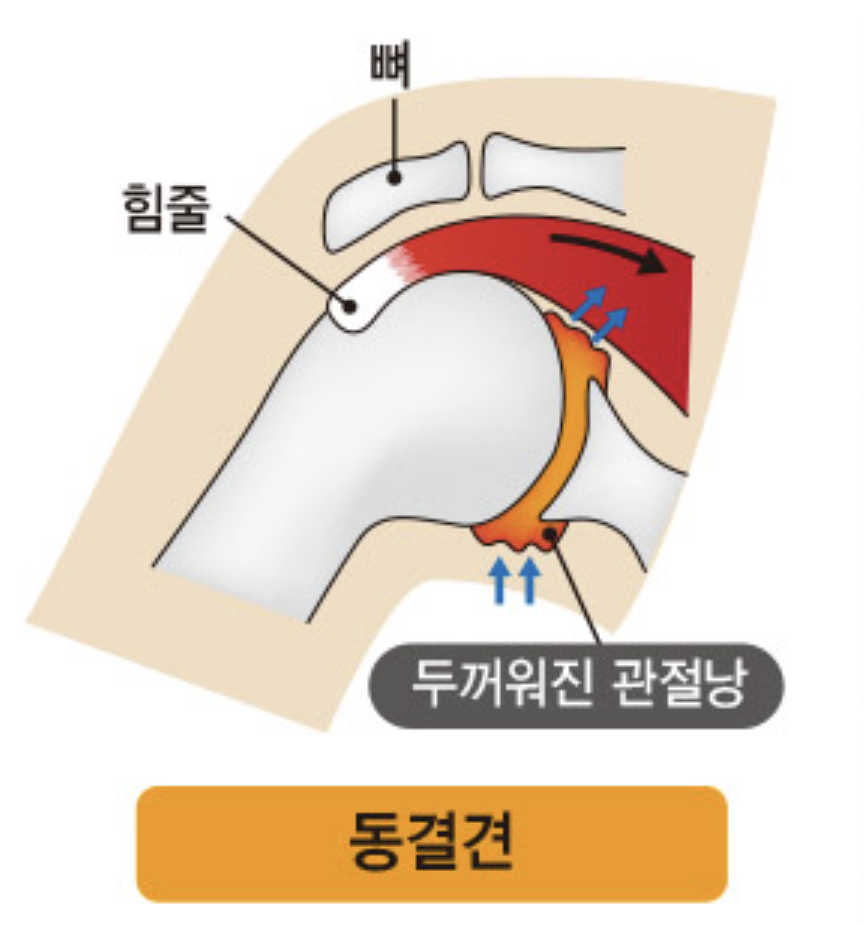 오십견-어깨-설명