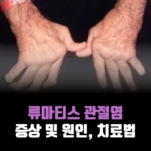 류마티스-관절염-증상-원인