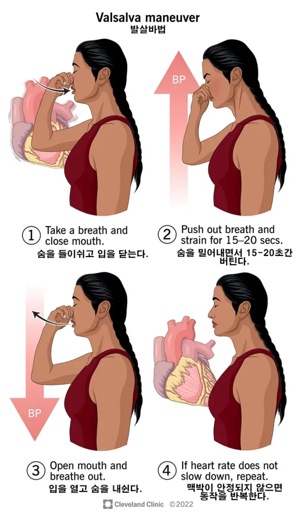 발살바-조작
