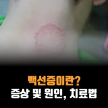 백선증-증상-원인-치료법
