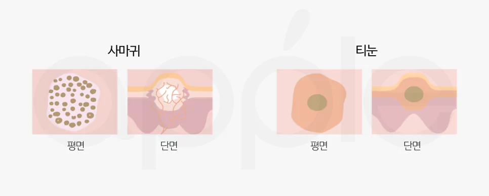 사마귀-티눈-차이