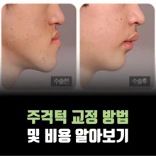 주걱턱-교정-방법-비용