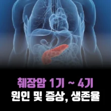 췌장암-1기-4기-원인-증상
