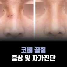 코뼈-골절-이미지