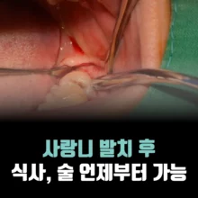 사랑니-발치-후-식사-술-흡연