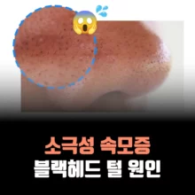 소극성-속모증-블랙헤드-털