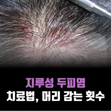 지루성-두피염-치료-방법