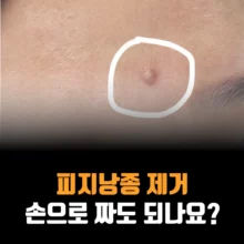 피지낭종-제거-표피낭종