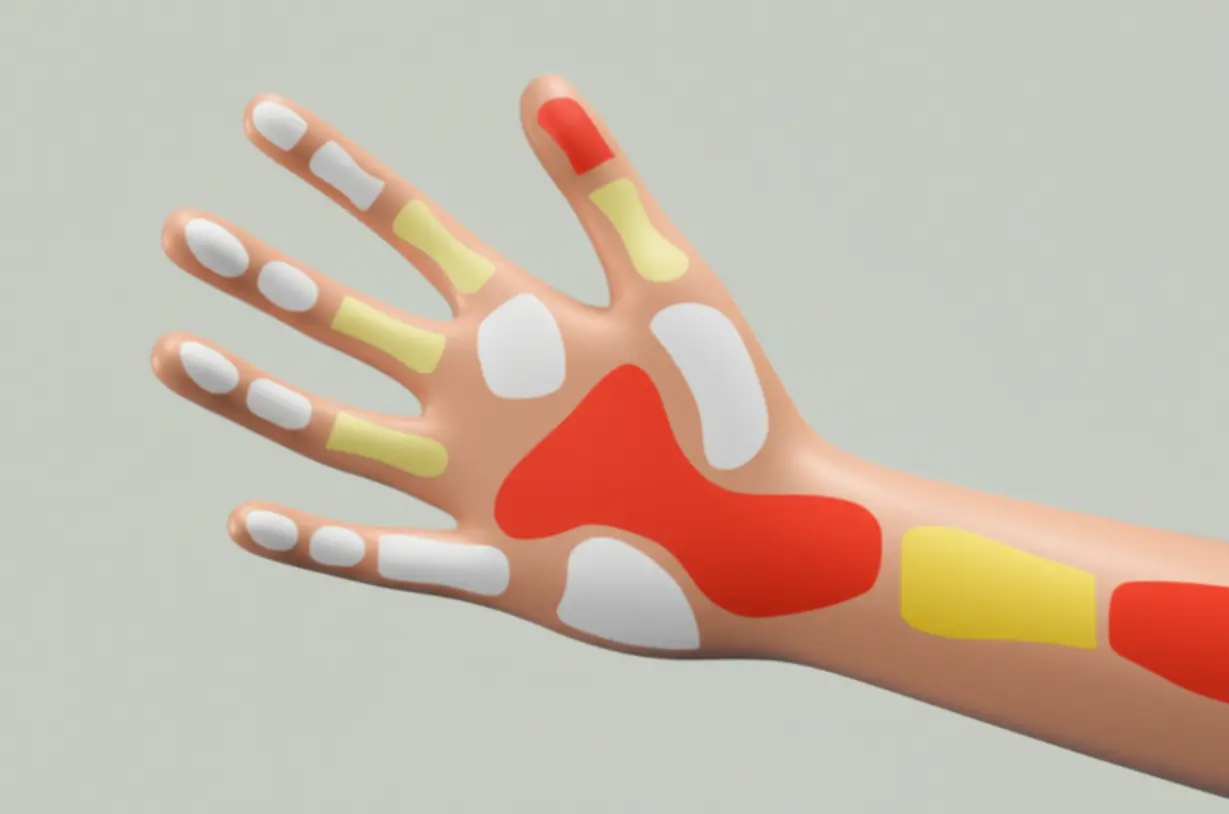 Illustration-showing-different-areas-of-the-hand-potentially-affected-by-common-causes-of-numbness-like-carpal-tunnel-or-neck-issues,-depicted-with-abstract-shapes.